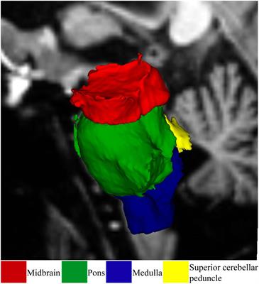 Brainstem volume changes in myalgic encephalomyelitis/chronic fatigue syndrome and long COVID patients